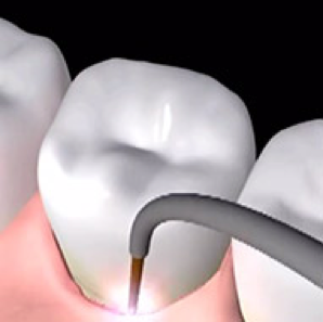 Laser Gum Surgery